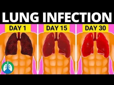 Top 10 Natural Lung Infection Treatments (Home Remedies)