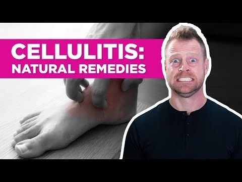 Are There Natural Remedies for Cellulitis?