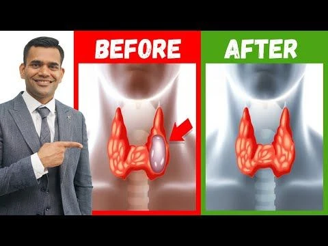 How To Shrink Thyroid Nodules Naturally | Effective Natural Treatment Of Thyroid Nodules