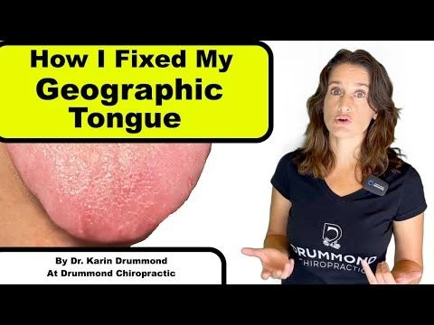 Geographic Tongue - Natural Remedies That Work