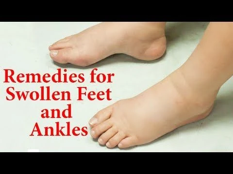 10 Natural Remedies For Swollen Feet And Ankles |  Ways to Reduce EDEMA Naturally at Home |