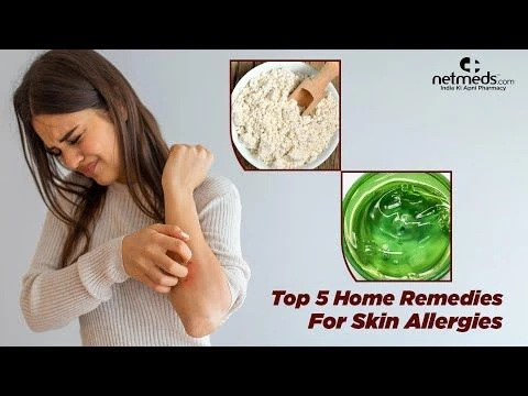 5 Best Natural Remedies For Skin Allergies