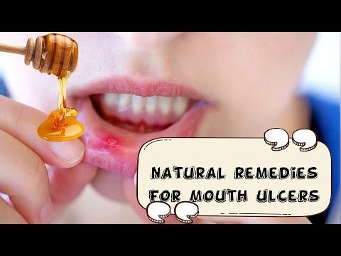 How To Relieve Mouth Ulcers Naturally And Effectively |Natural Remedies For Mouth Ulcers/Canker Sore