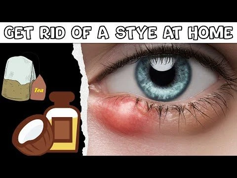 How To Get Rid Of A Stye At Home |Natural Remedies For Stye |Best Ways To Get Rid Of A Stye Easily