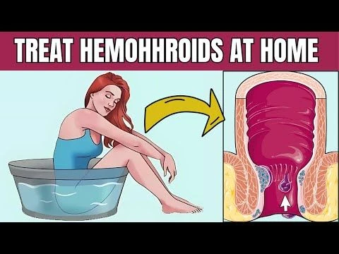 6 Natural Ways To Treat Hemorrhoids Quickly And Effectively |Treat Hemorrhoids At Home |Home Remedy