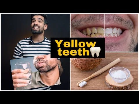 Yellow Teeth Cure *Natural*🦷🥥 #shorts #yellowteeth