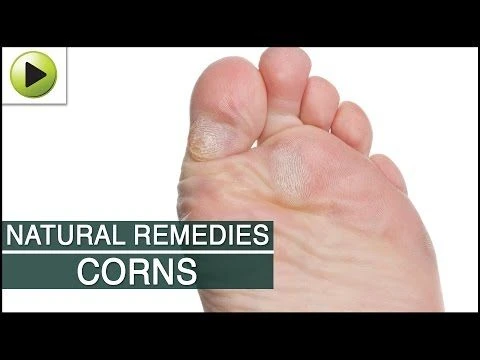 Skin Care - Corns - Natural Ayurvedic Home Remedies