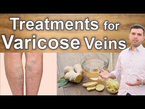 Natural Cures for Varicose Veins – 10 Best Supplements, Herbs and Diets for Varicose