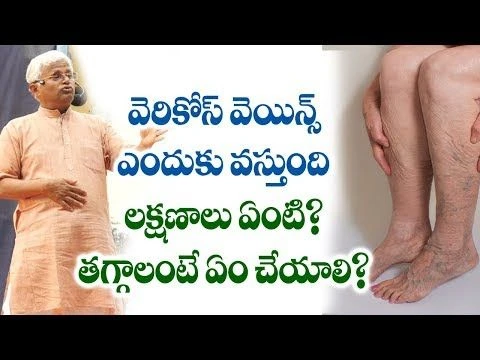 Varicose veins || Causes || Symptoms || Natural Treatment || Dr.KhaderVali