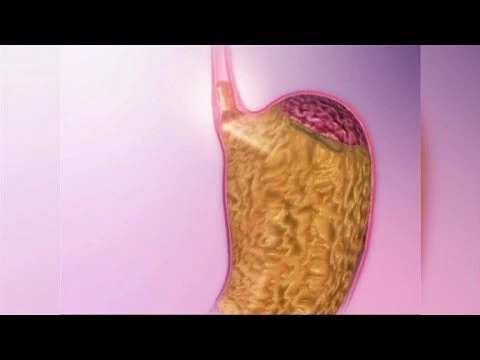 Acid Reflux Natural Remedies