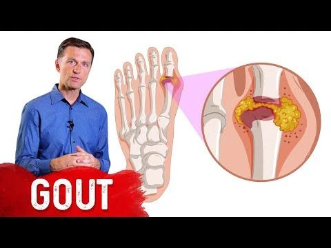 The 7 Natural Remedies for Gout